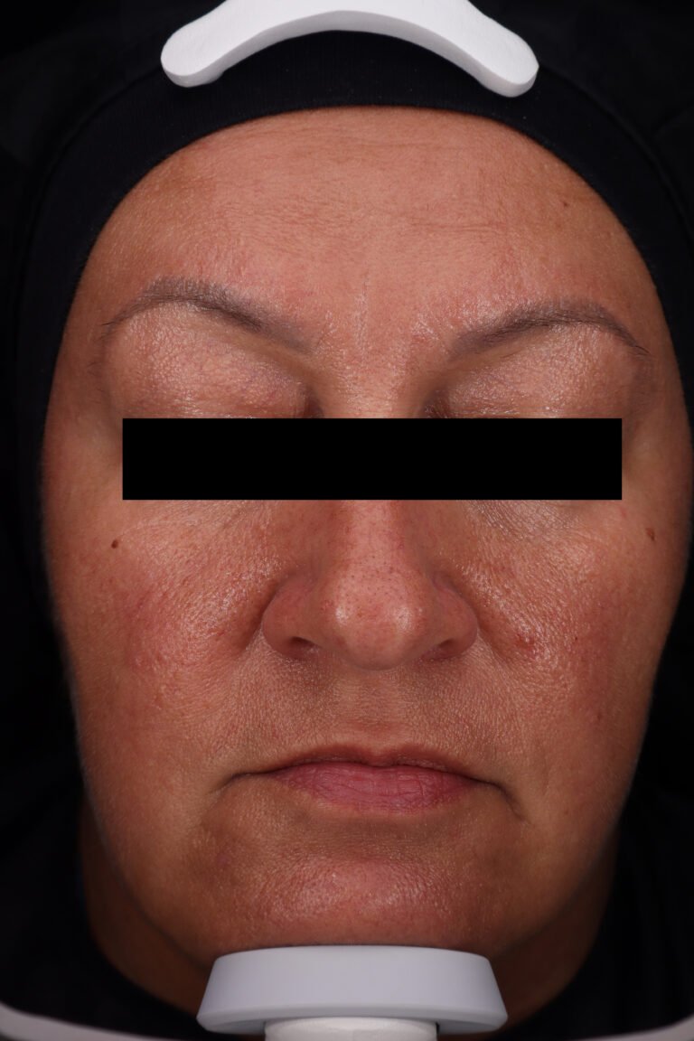 VISIA® clinical image — after 28 days of Daily Bloom serum, showing reduced wrinkles, smoother texture, more even tone and improved radiance.