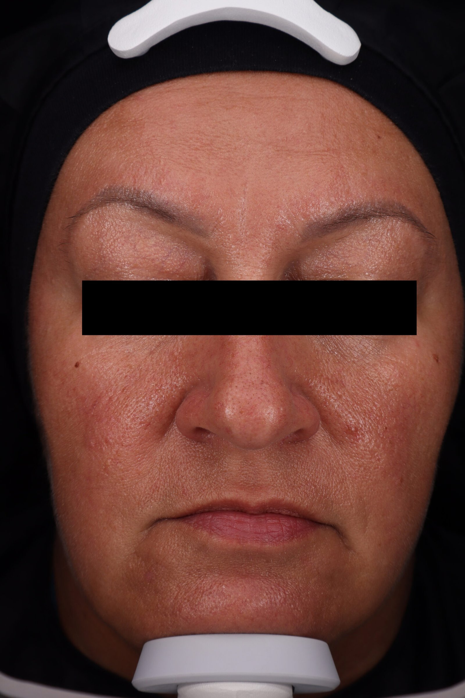 VISIA® clinical image — after 28 days of Daily Bloom serum, showing reduced wrinkles, smoother texture, more even tone and improved radiance.