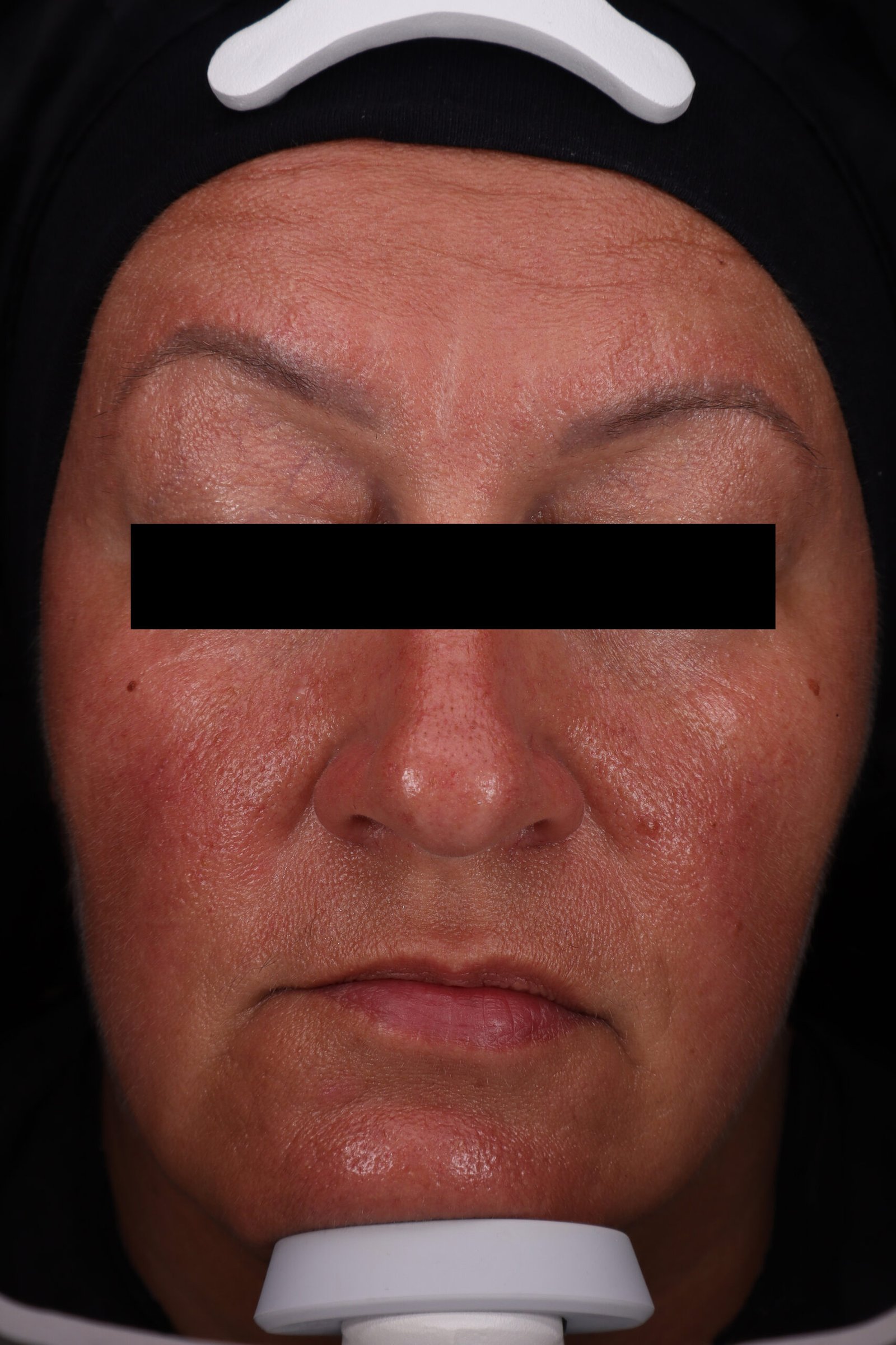 VISIA® clinical image — baseline before use of Daily Bloom serum, showing wrinkles, uneven tone and visible redness.