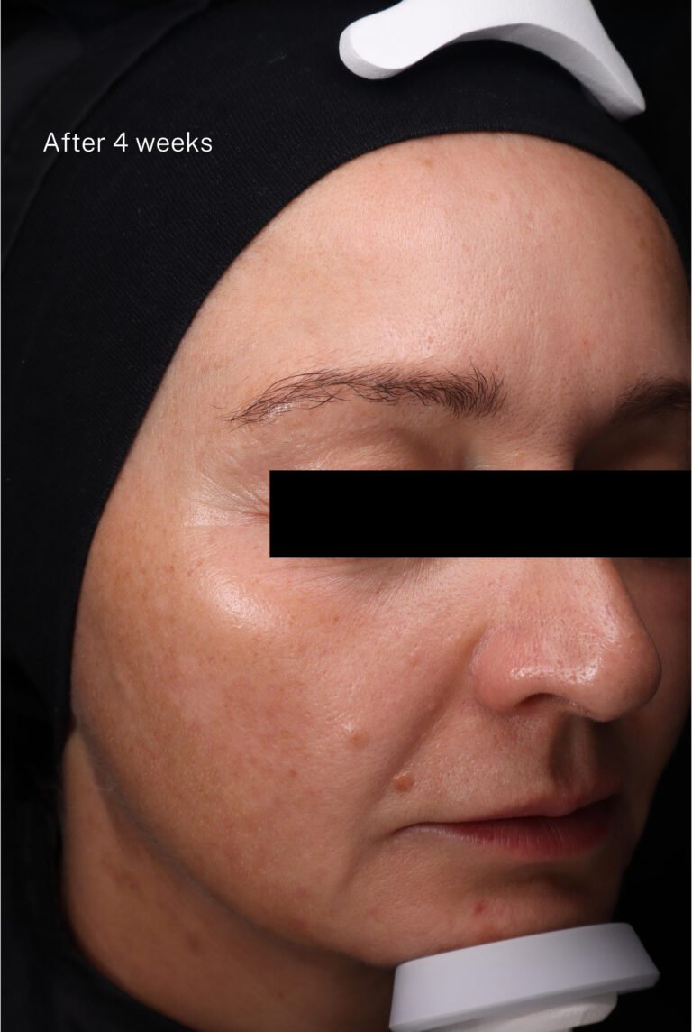 After VISIA® clinical images, right profile — reduction of periocular wrinkles, smoother texture, more even tone and luminosity, with visibly improved firmness and definition of the cheek and jawline after 28 days of Daily Bloom serum